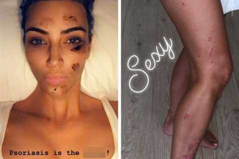Kim Kardashian gives fans intimate look at doctor’s visit to treat her dyschromia skin disorder..