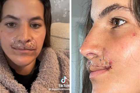 Brooklinn Khoury Shows Off Results of Latest Lip Reconstruction Surgery, Details Procedure