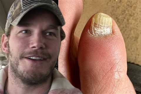 Chris Pratt Diagnosed With Toe Fungus by 'My Feet Are Killing Me' Doctor