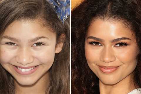 Zendaya -- Good Genes Or Good Docs?!