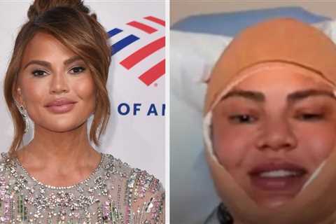 Chrissy Teigen Broke Her Silence After A Photo Of Her Bandaged Face Sparked Concern