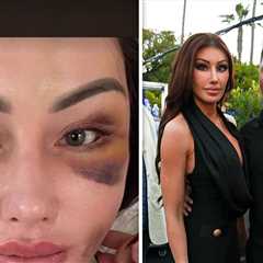 Holly Sonders Shows Gnarly Bruises After Filler Removal