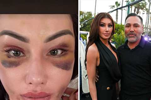 Holly Sonders Shows Gnarly Bruises After Filler Removal