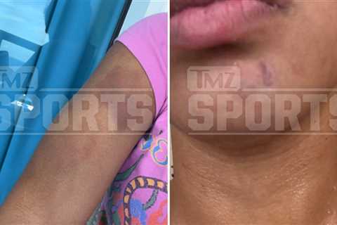 Browns' Quinshon Judkins Ex's Alleged Injury Photos Show Mark On Chin, Bruising