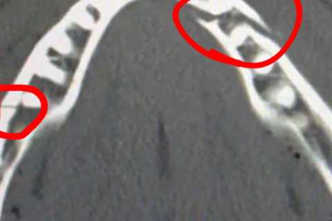 Jake Paul reveals jarring extent of jaw injury after post-fight surgery