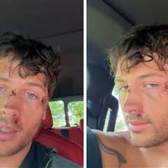 'Traitors' Winner Rob Rausch Banged Up Bad After Bike Slams Into Dog